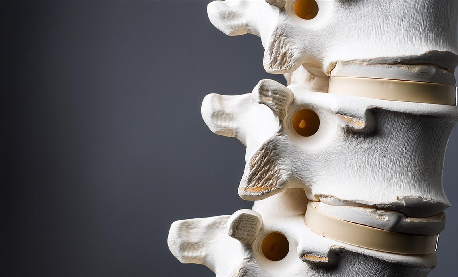 ¿Es Necesario Operarse por una Hernia Discal? Un Enfoque Personal